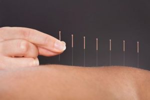 Acupuncture treatment in Chapel Hill, NC