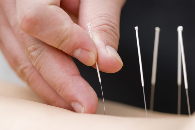 acupuncture on back