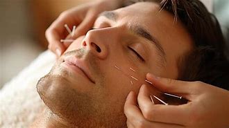 acupuncture on face